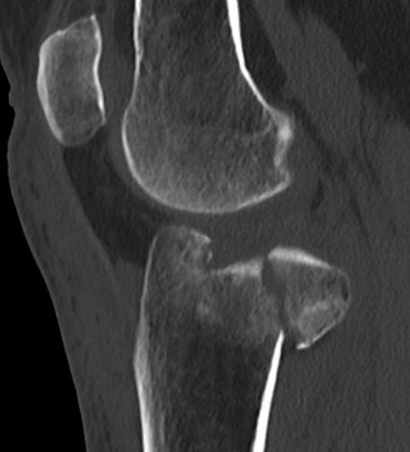 Posterolateral Tibial Plateau